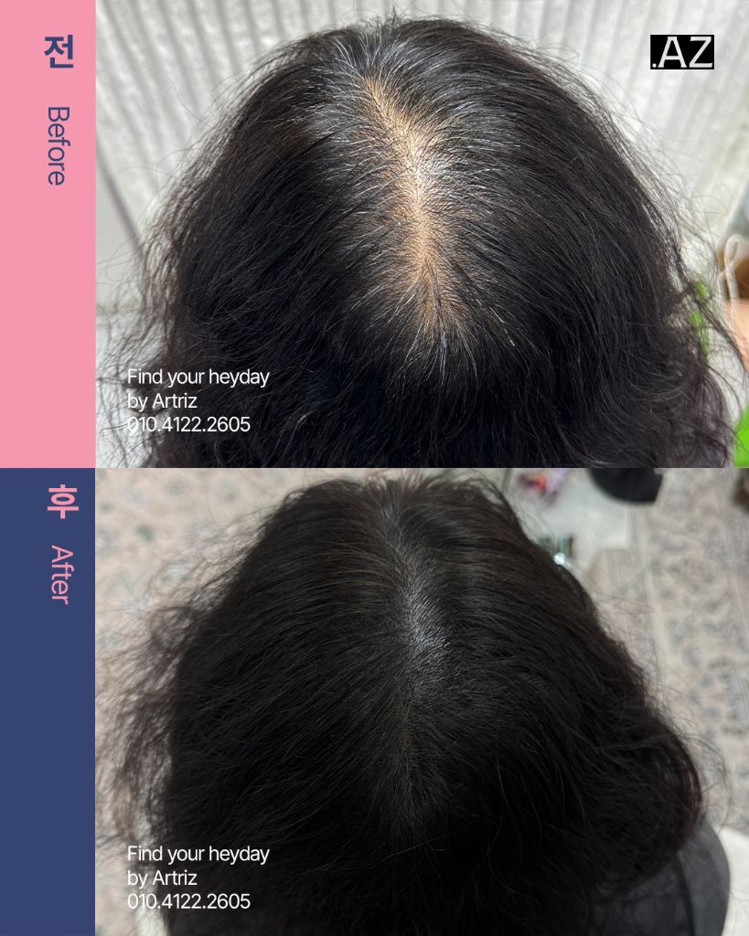 가르마 정수리 두피문신 before after