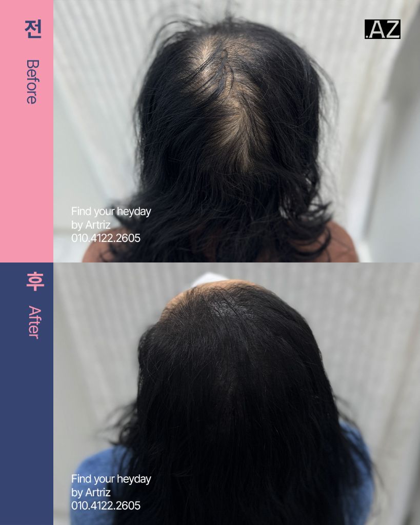 가르마 정수리 두피문신 before after