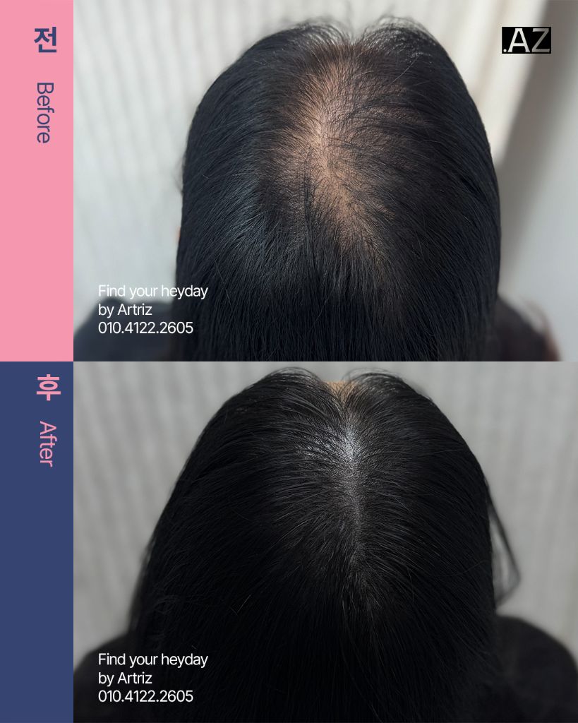 가르마 정수리 두피문신 before after