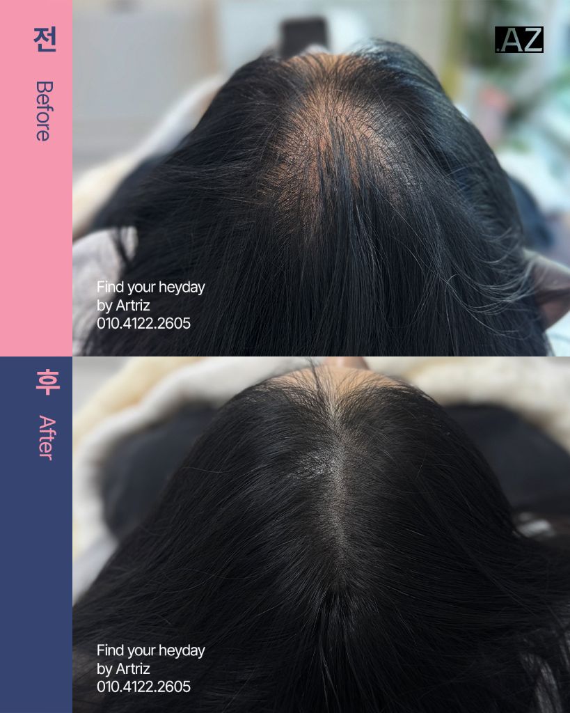 가르마 정수리 두피문신 before after