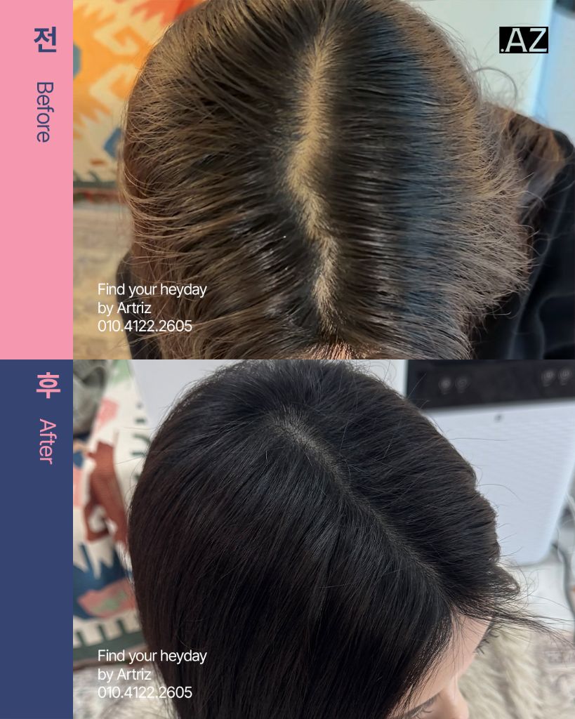 가르마 정수리 두피문신 before after