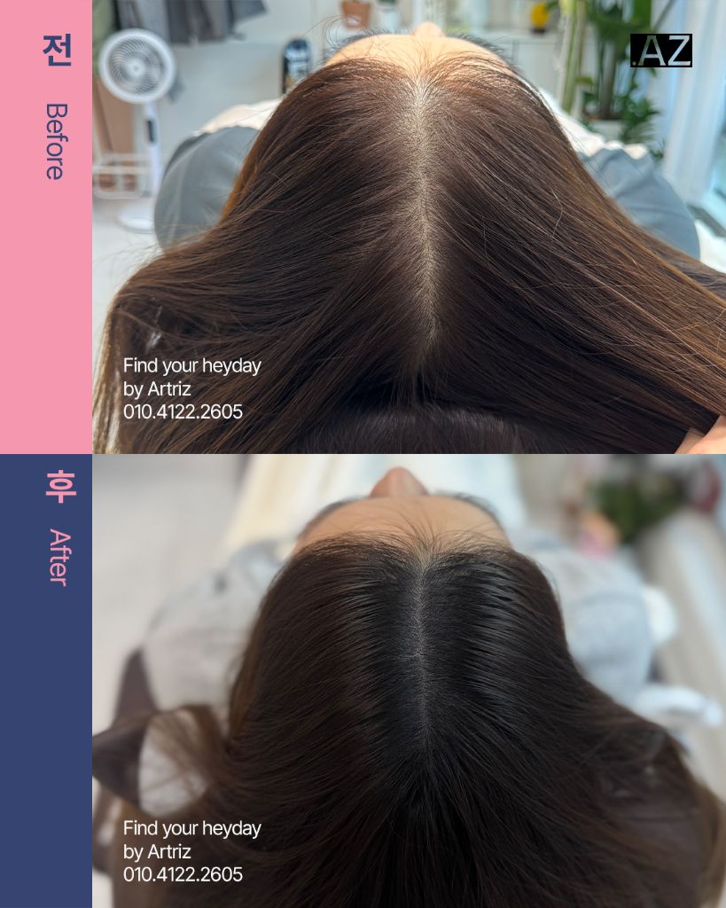 가르마 정수리 두피문신 before after