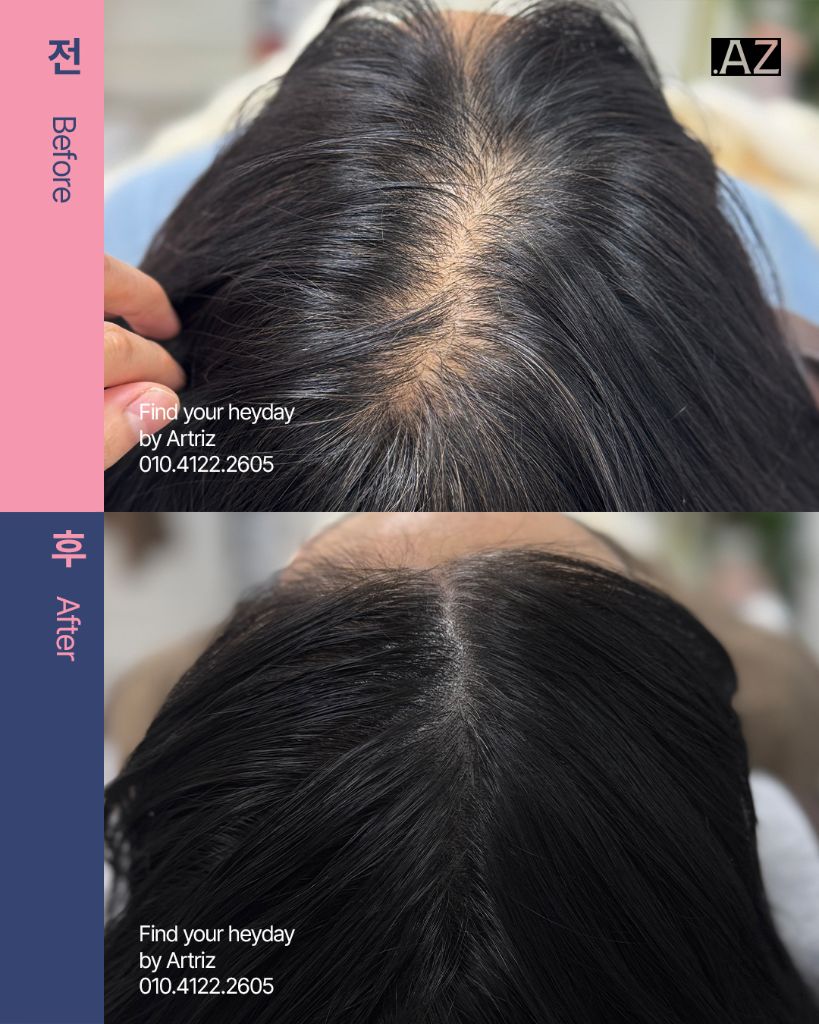 가르마 정수리 두피문신 before after