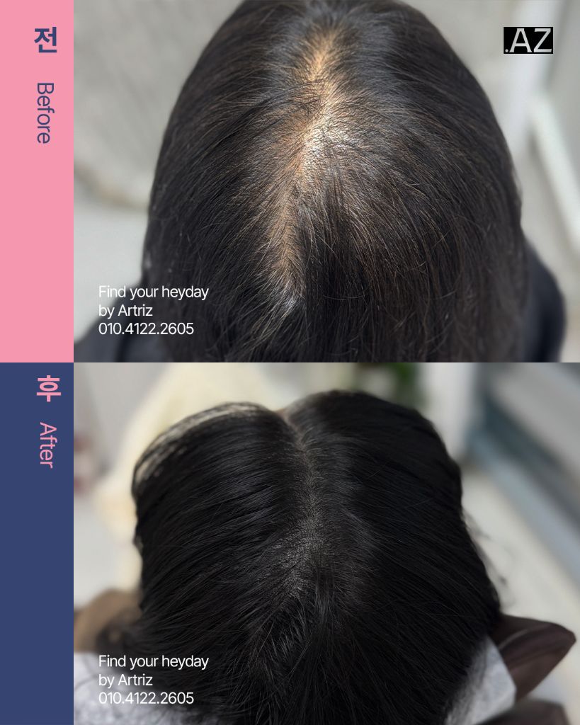 가르마 정수리 두피문신 before after