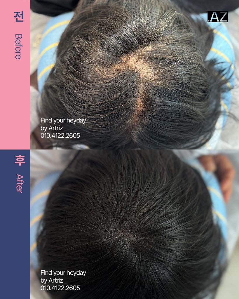 가르마 정수리 두피문신 before after