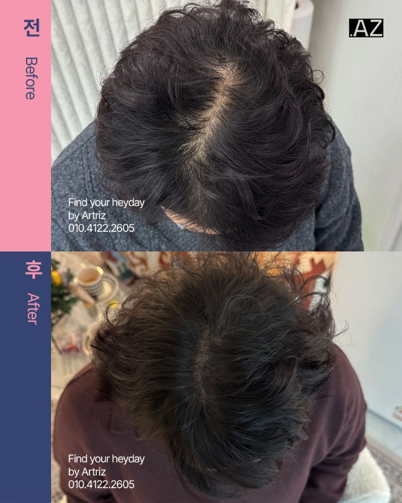 가르마 정수리 두피문신 before after