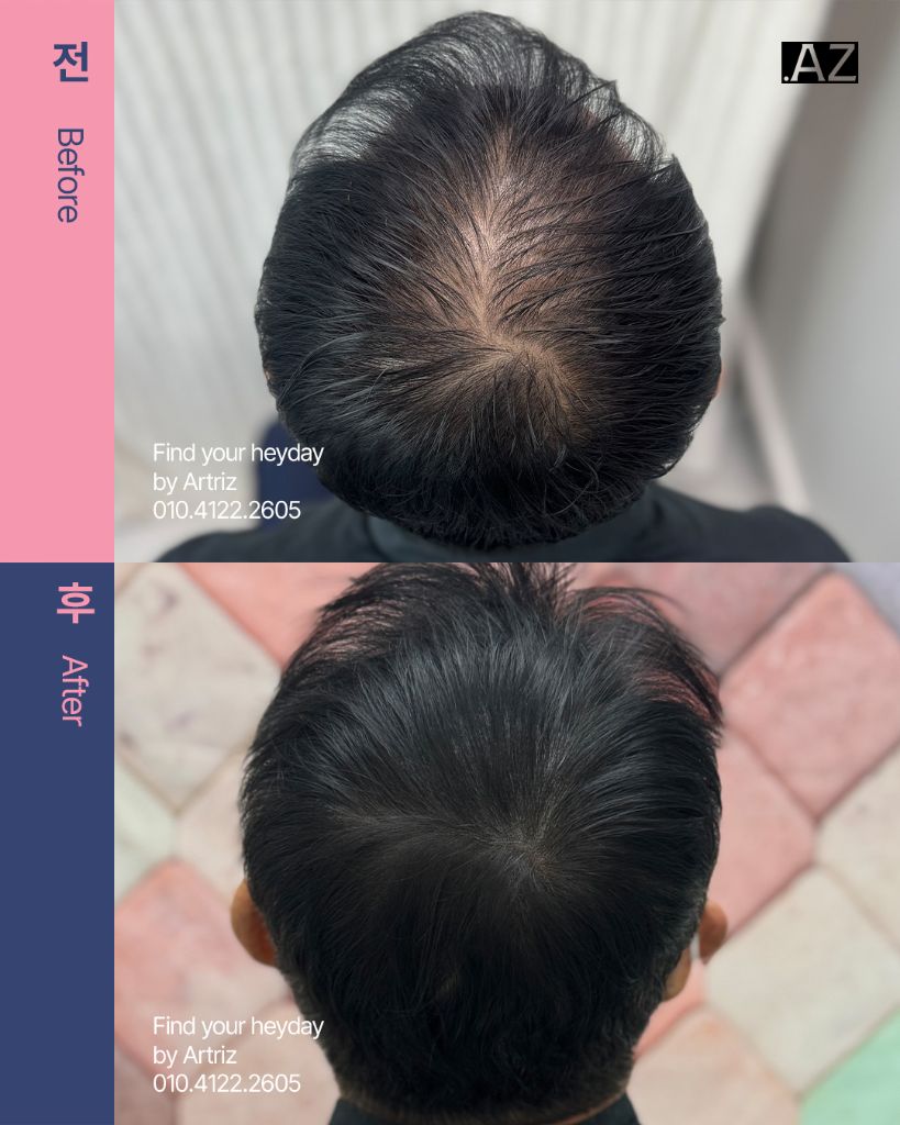 가르마 정수리 두피문신 before after