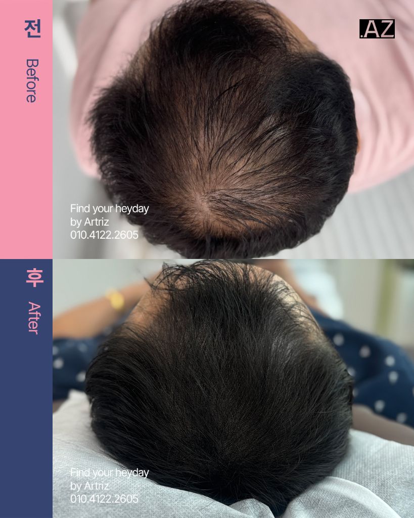 가르마 정수리 두피문신 before after