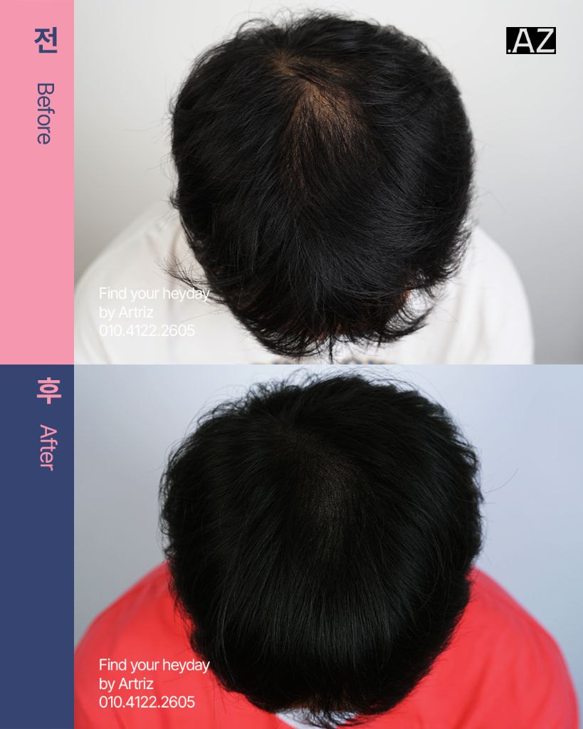 가르마 정수리 두피문신 before after