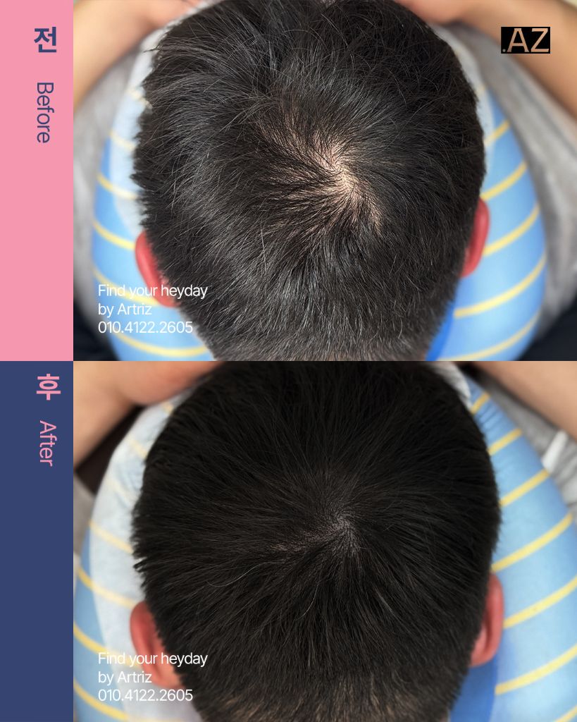 가르마 정수리 두피문신 before after