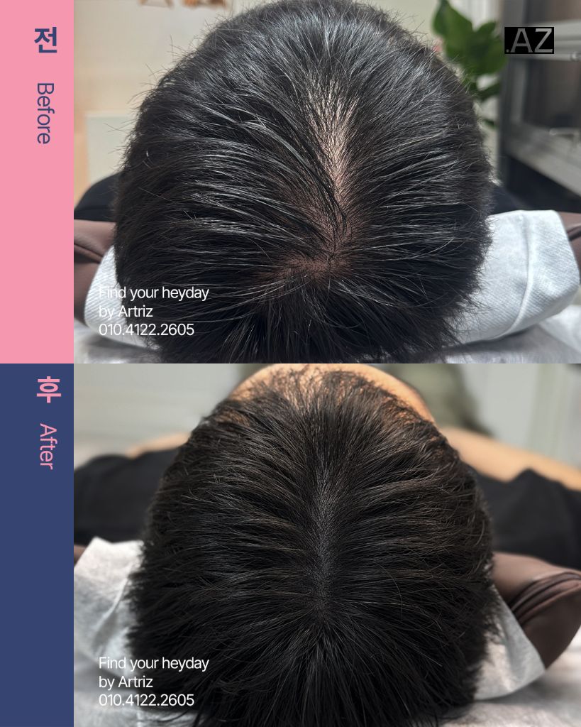 가르마 정수리 두피문신 before after