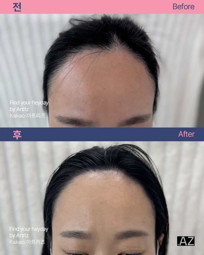 여성 헤어라인 두피문신 before after