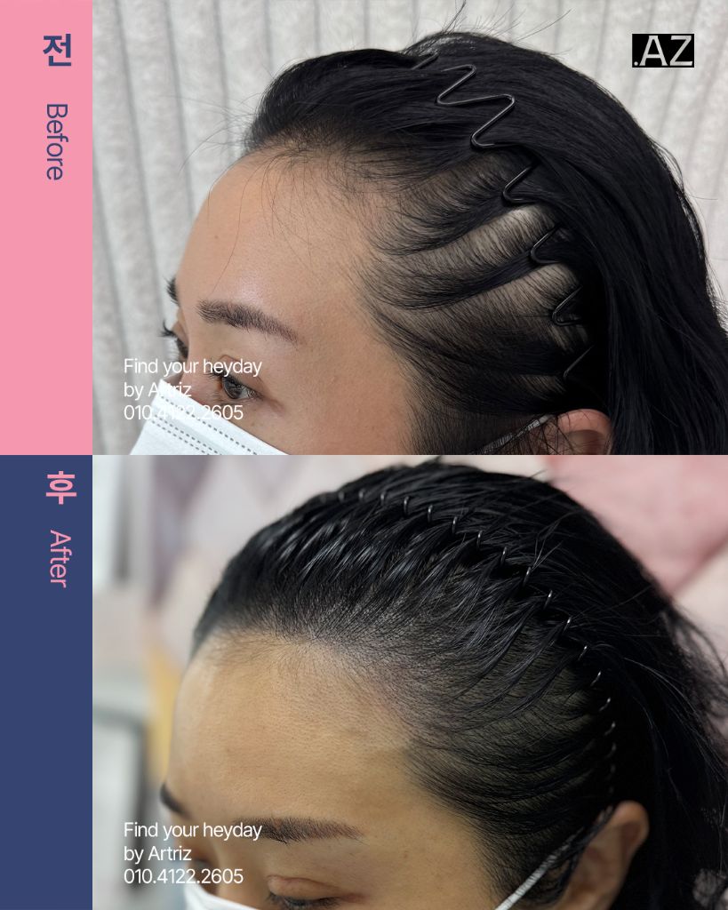 여성 헤어라인 두피문신 before after