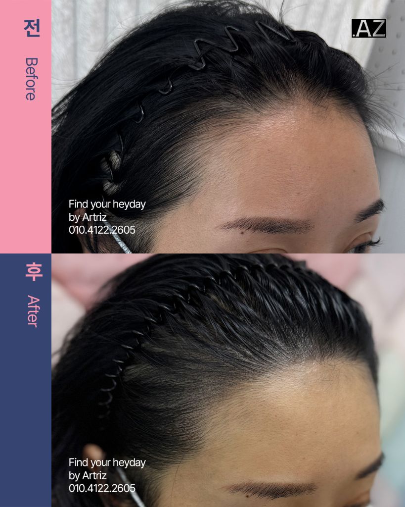 여성 헤어라인 두피문신 before after