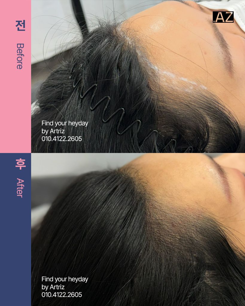 여성 헤어라인 두피문신 before after