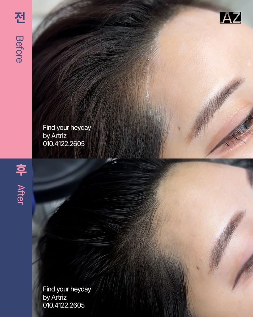 여성 헤어라인 두피문신 before after