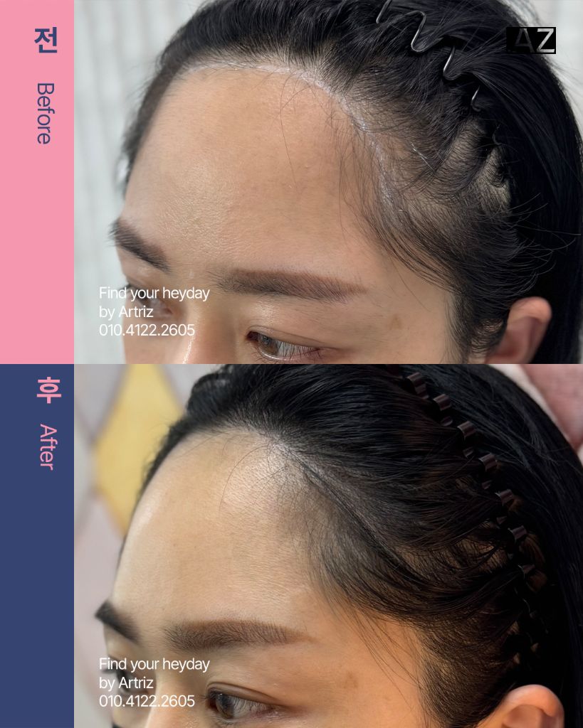 여성 헤어라인 두피문신 before after