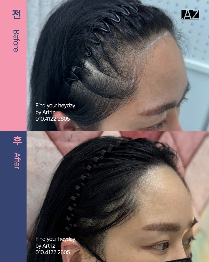 여성 헤어라인 두피문신 before after