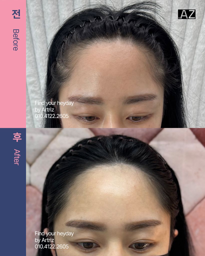 여성 헤어라인 두피문신 before after