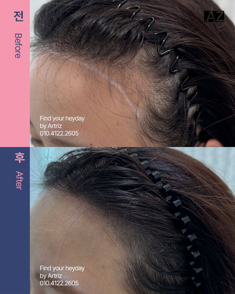 여성 헤어라인 두피문신 before after