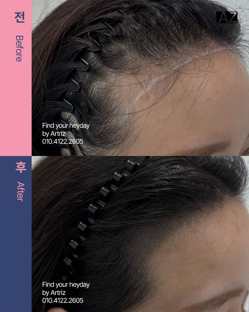여성 헤어라인 두피문신 before after
