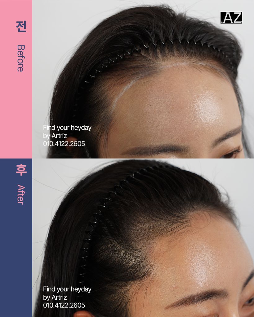 여성 헤어라인 두피문신 before after