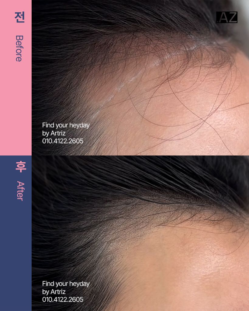 여성 헤어라인 두피문신 before after