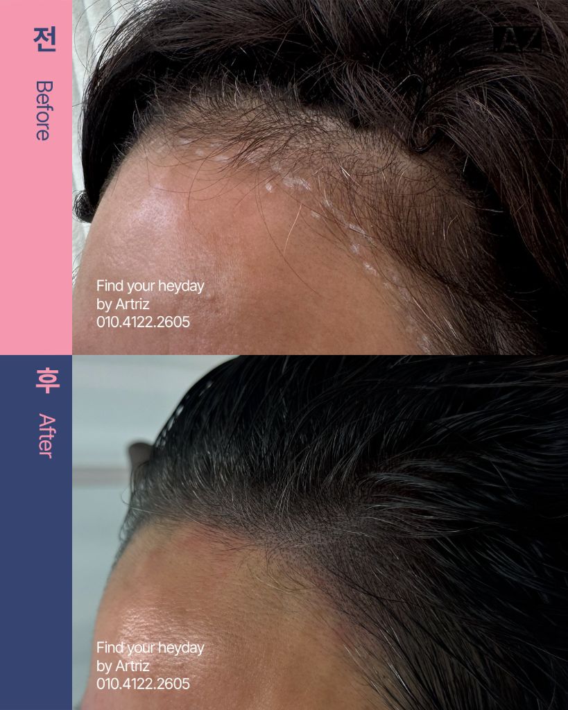 여성 헤어라인 두피문신 before after