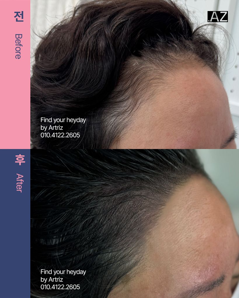 여성 헤어라인 두피문신 before after