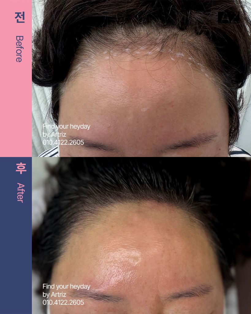 여성 헤어라인 두피문신 before after