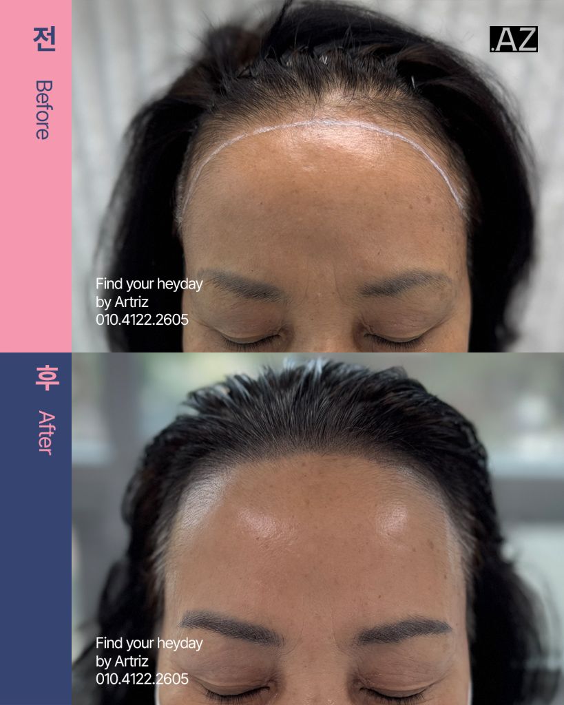 여성 헤어라인 두피문신 before after