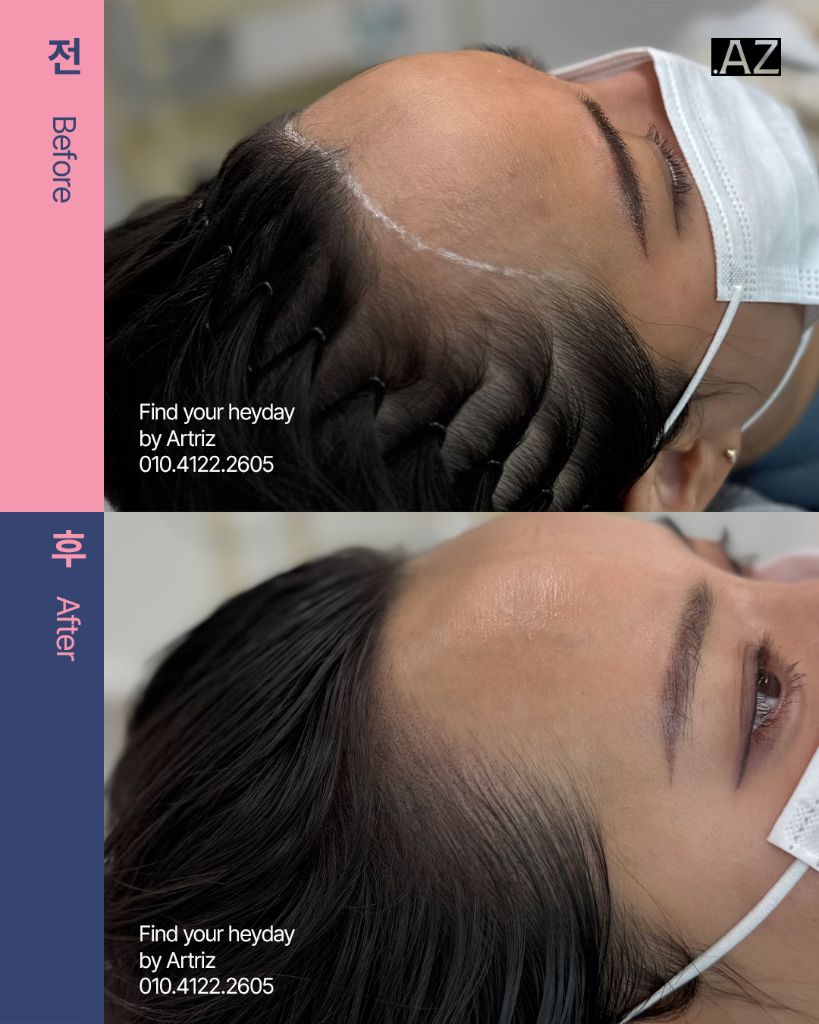 여성 헤어라인 두피문신 before after