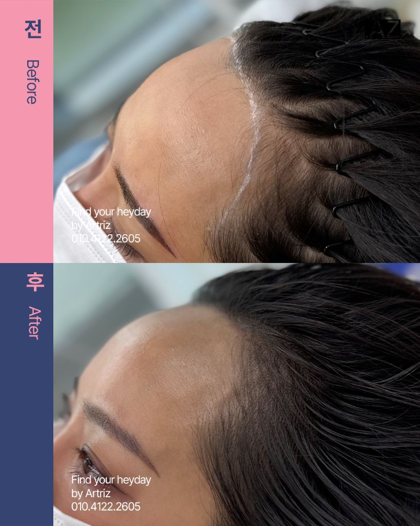여성 헤어라인 두피문신 before after