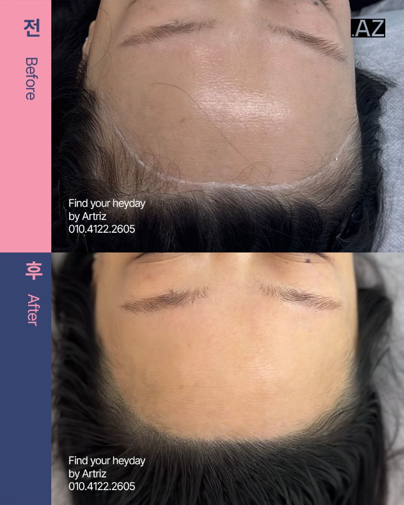 여성 헤어라인 두피문신 before after