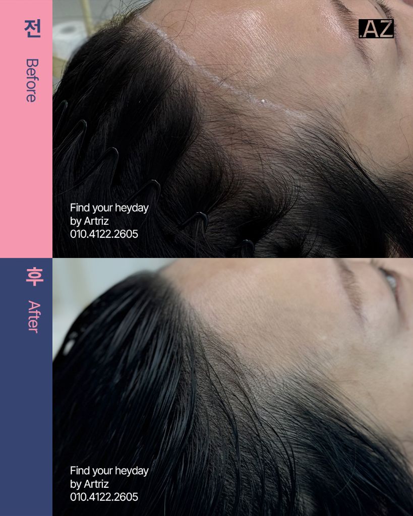 여성 헤어라인 두피문신 before after