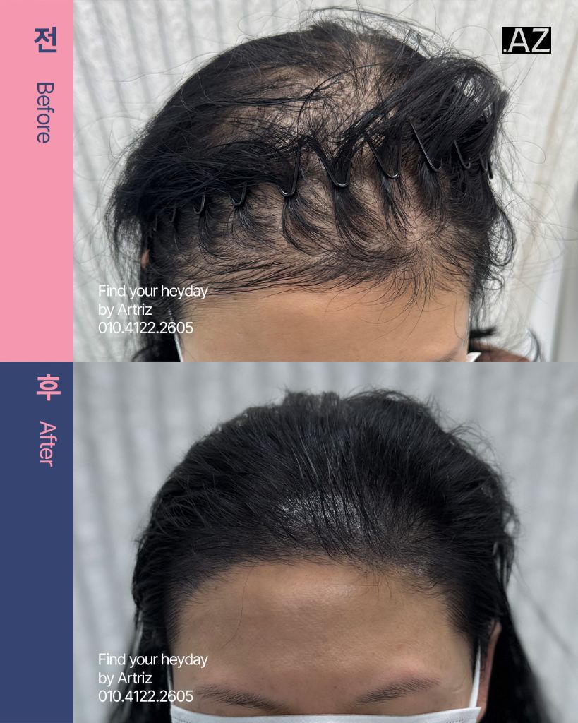 여성 헤어라인 두피문신 before after