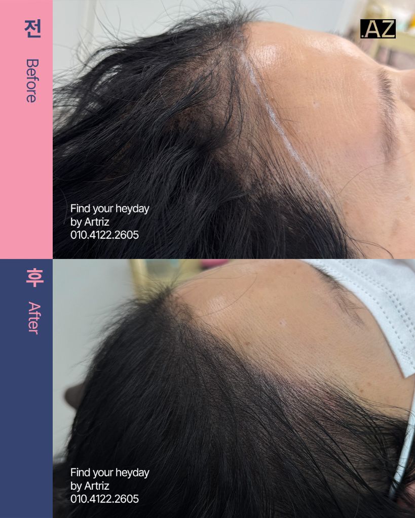 여성 헤어라인 두피문신 before after