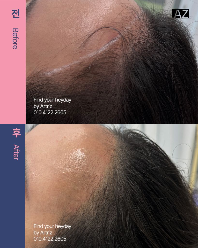 여성 헤어라인 두피문신 before after