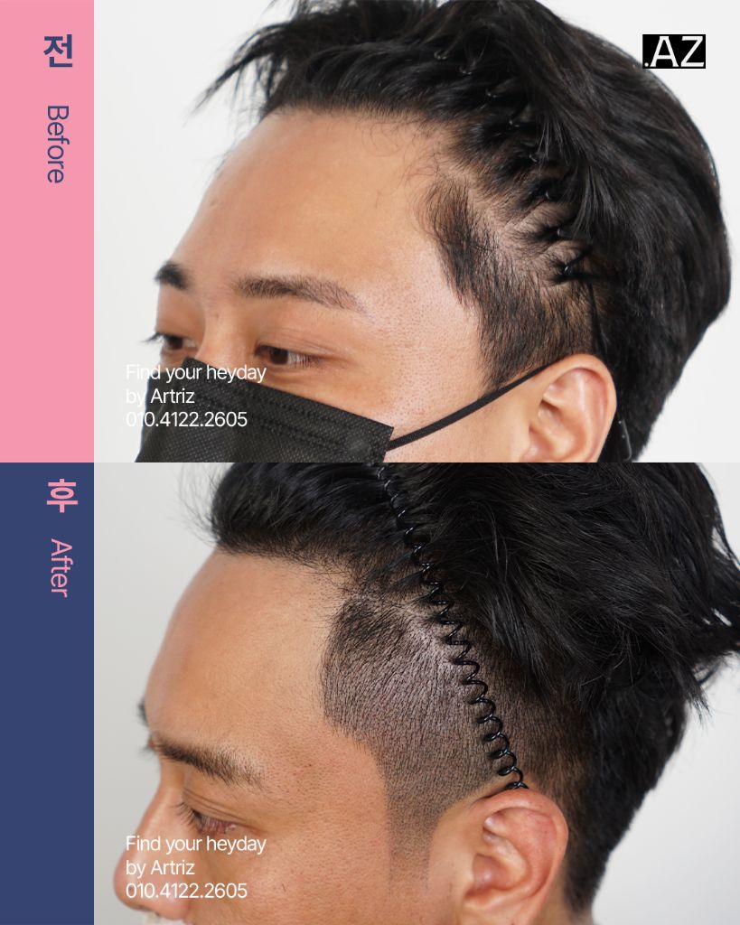 남성 헤어라인 두피문신 before after