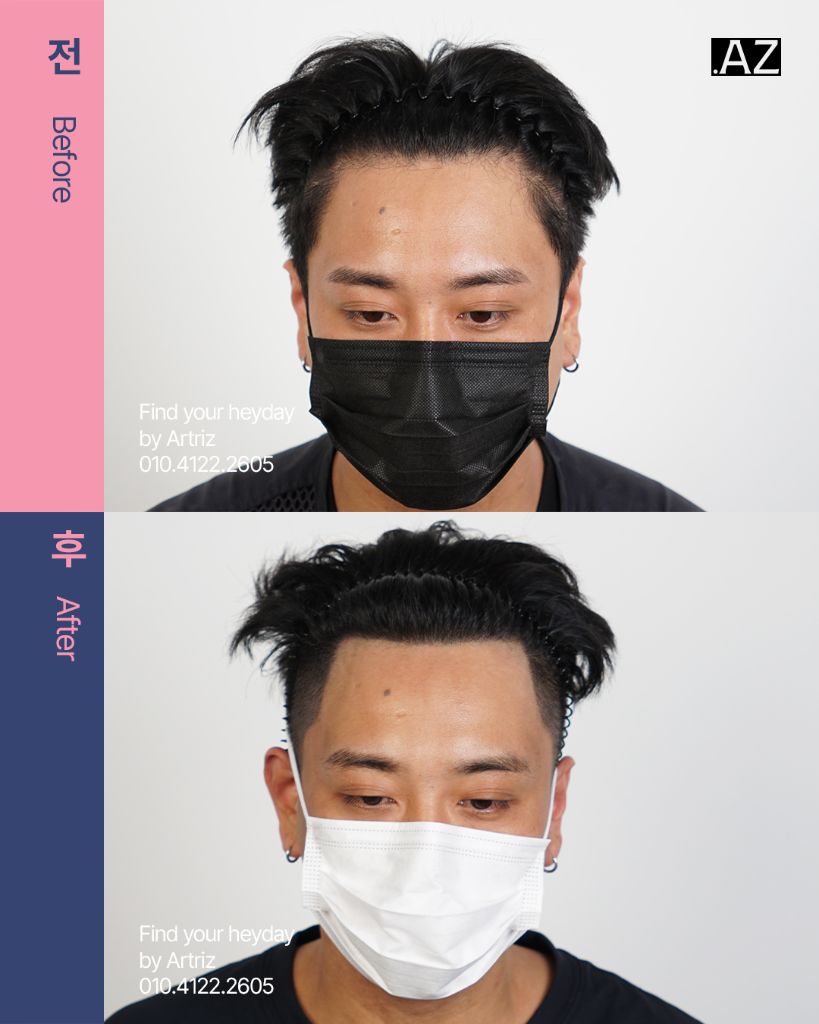 남성 헤어라인 두피문신 before after