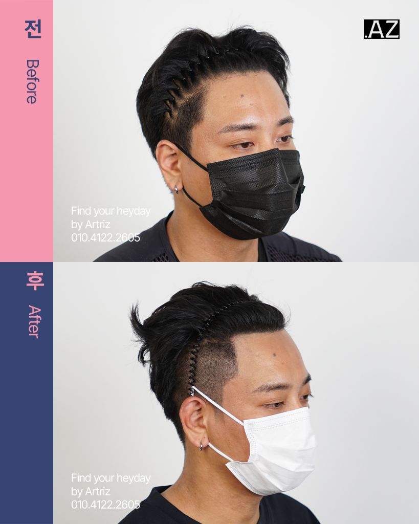 남성 헤어라인 두피문신 before after