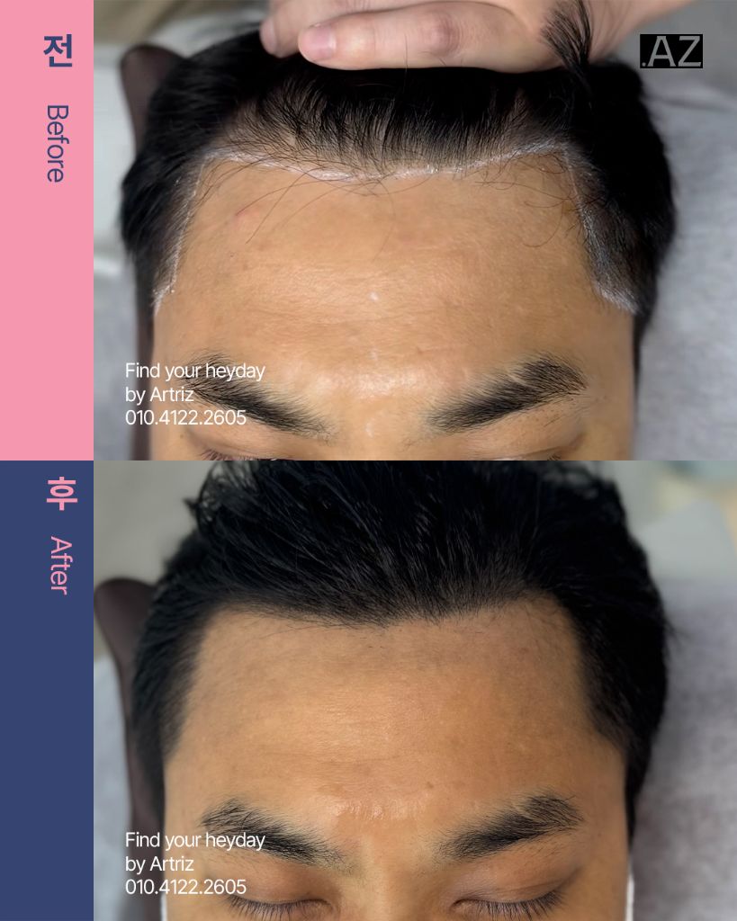 남성 헤어라인 두피문신 before after