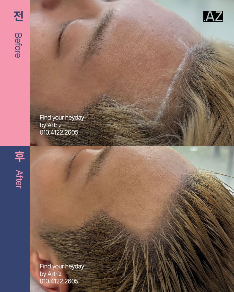 남성 헤어라인 두피문신 before after