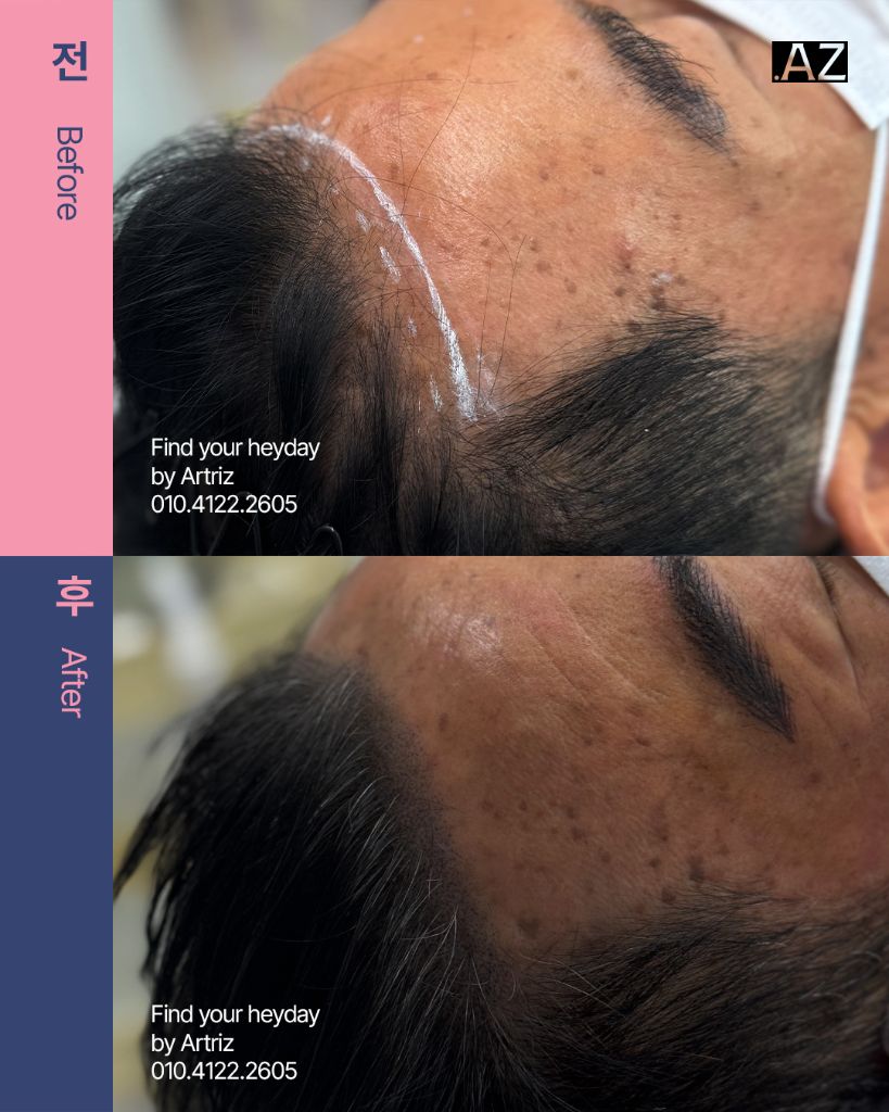 남성 헤어라인 두피문신 before after