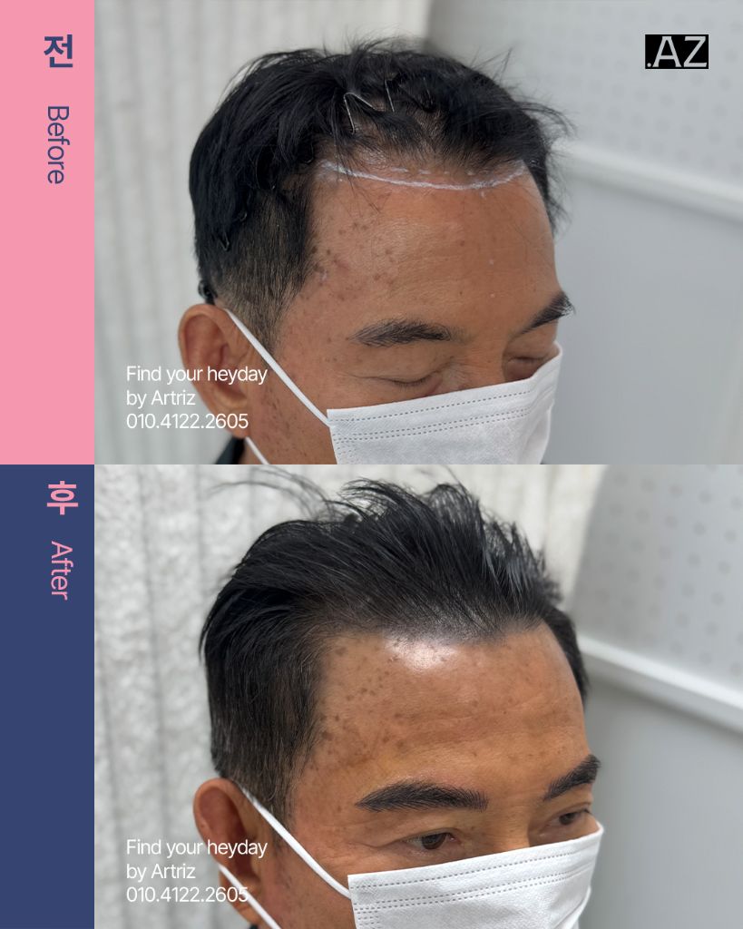 남성 헤어라인 두피문신 before after