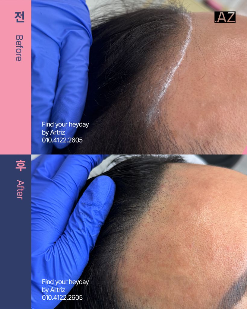 남성 헤어라인 두피문신 before after