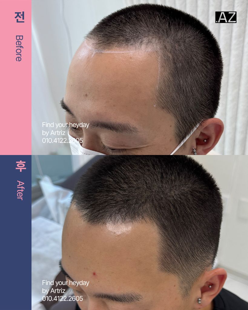 남성 헤어라인 두피문신 before after