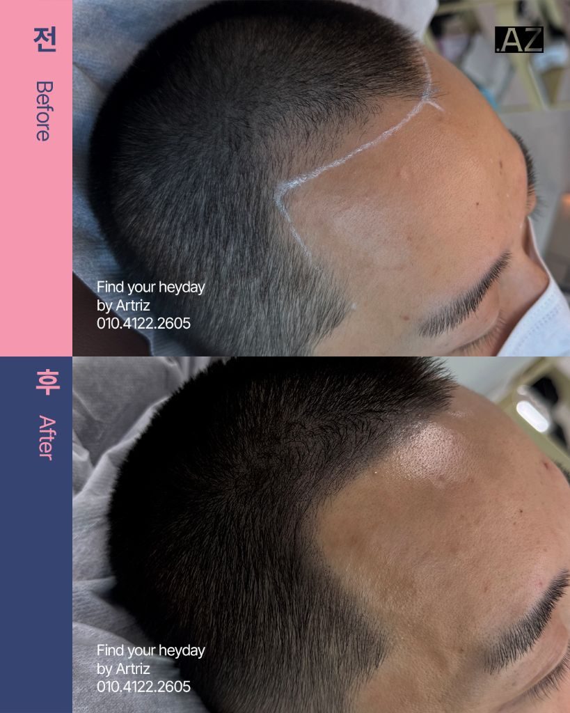 남성 헤어라인 두피문신 before after