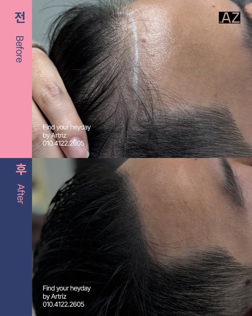 남성 헤어라인 두피문신 before after