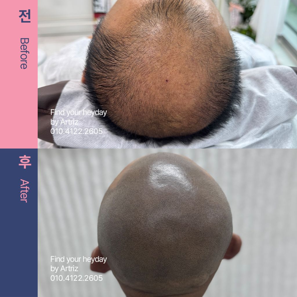 삭발 디자인 두피문신 before after